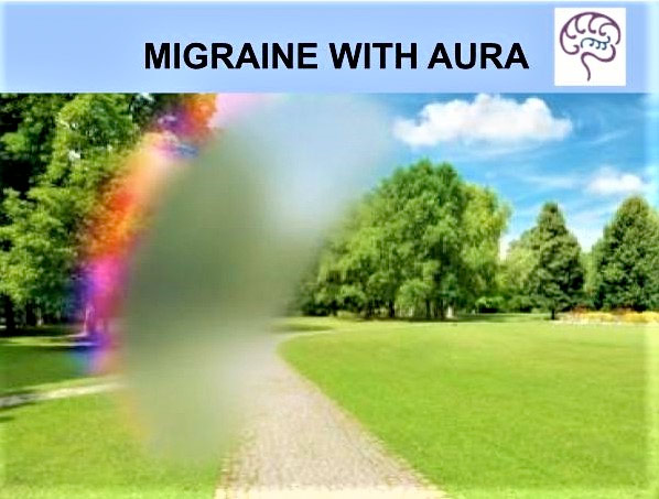 migraine aura vs seizure aura